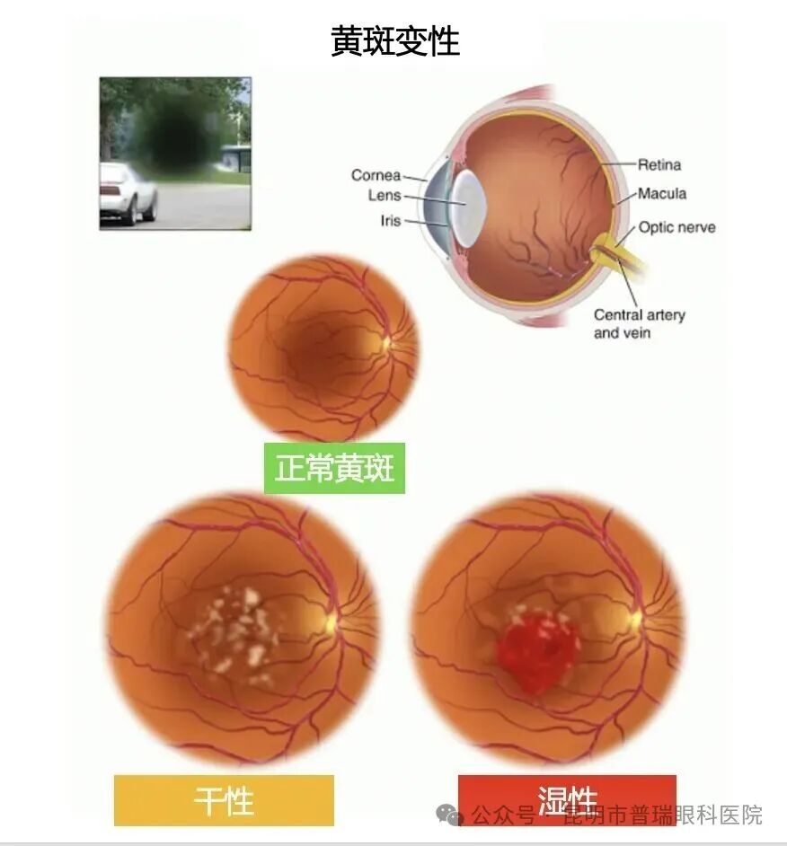 别把“老眼昏花”当正常！50+必看：黄斑变性的早期信号 | 昆明普瑞眼科医院牛志强博士科普