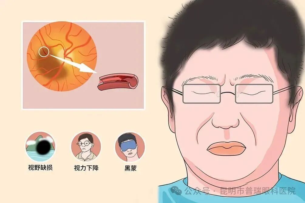 这两种眼底危机，哪怕只持续几秒，也需立即就医！昆明普瑞眼科牛志强博士科普视网膜中央动脉阻塞 黄斑病变 视网膜脱离