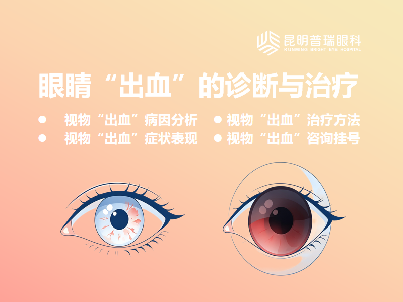 昆明普瑞眼科医院科普：什么是自发性结膜下出血？